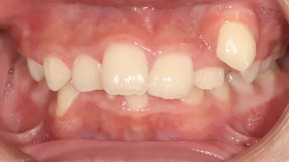 マウスピース矯正の治療効果その2-1:治療前