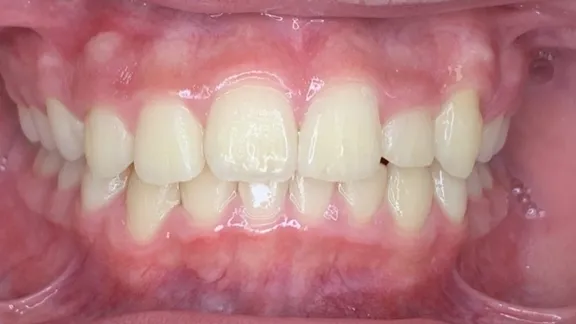 マウスピース矯正の治療効果その2-2:治療後