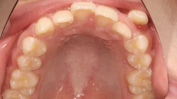 マウスピース矯正の治療効果その2-3:治療前