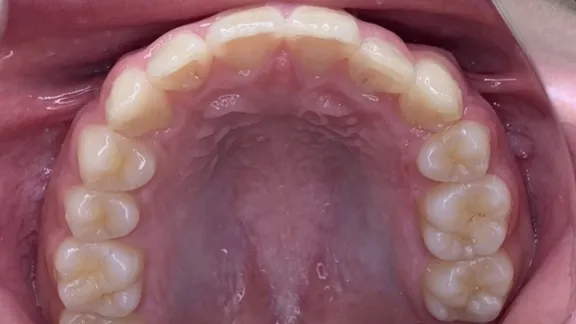 マウスピース矯正の治療効果その2-4:治療後