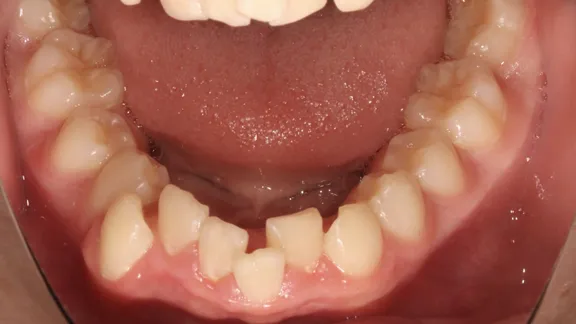 マウスピース矯正の治療効果その2-5:治療前