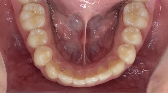 マウスピース矯正の治療効果その2-6:治療後