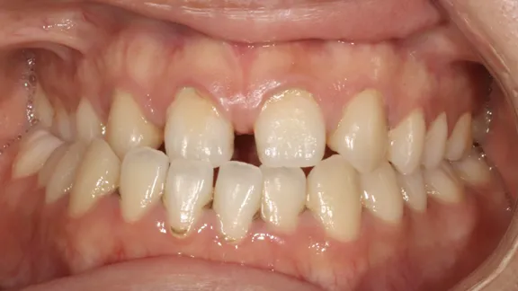 マウスピース矯正の治療効果その3-1:治療前