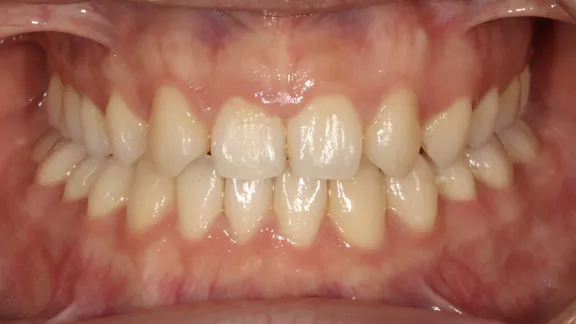 マウスピース矯正の治療効果その3-2:治療後