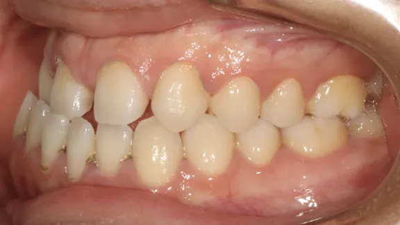 マウスピース矯正の治療効果その3-3:治療前