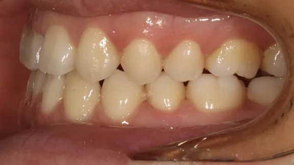 マウスピース矯正の治療効果その3-4:治療後