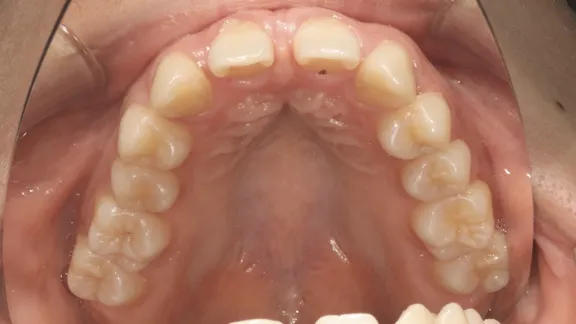 マウスピース矯正の治療効果その3-5:治療前