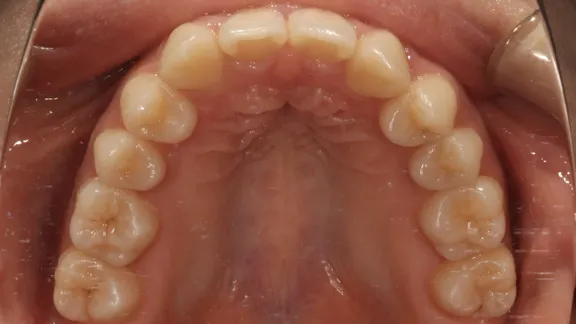 マウスピース矯正の治療効果その3-6:治療後