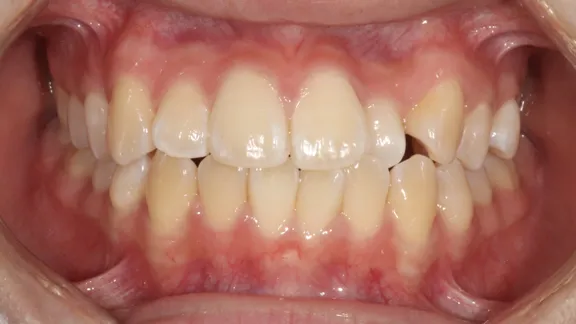 マウスピース矯正の治療効果その4-1:治療前