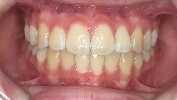 マウスピース矯正の治療効果その4-2:治療後