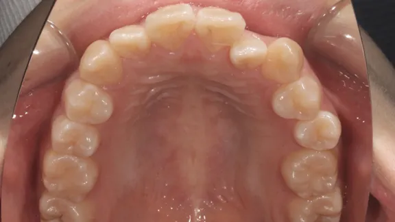 マウスピース矯正の治療効果その4-3:治療前