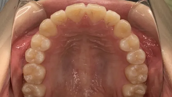 マウスピース矯正の治療効果その4-4:治療後