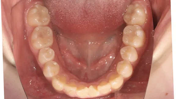 マウスピース矯正の治療効果その4-5:治療前