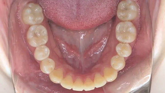 マウスピース矯正の治療効果その4-6:治療後