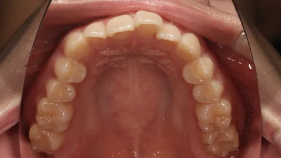 マウスピース矯正の治療効果その1-3:治療前
