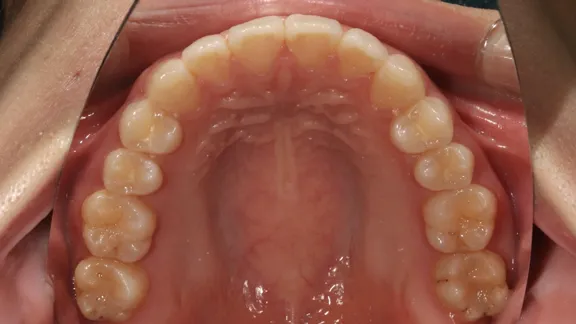 マウスピース矯正の治療効果その1-4:治療後