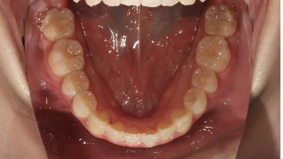 マウスピース矯正の治療効果その1-6:治療後