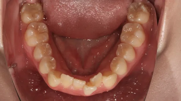 マウスピース矯正の治療効果その1-5:治療前