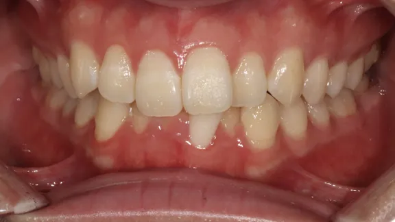 マウスピース矯正の治療効果その1-1:治療前