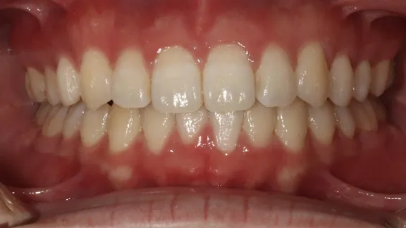 マウスピース矯正の治療効果その1-2:治療後