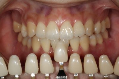 ホワイトニング前の歯の色を写真撮影