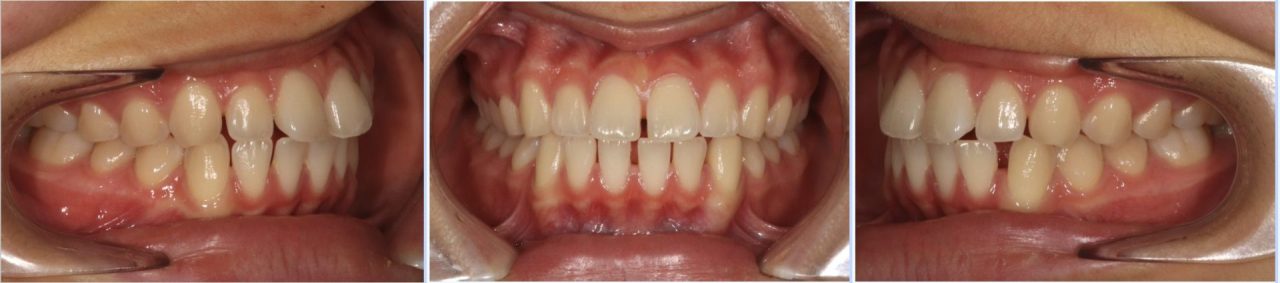 インビザライン、木更津、君津、袖ヶ浦、富津、こども、マウスピース。かみ合わせ　悪い　すきっ歯　すきま