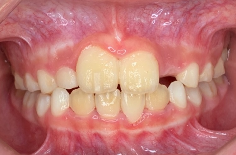 インビザライン、木更津、君津、袖ヶ浦、富津、こども、マウスピース。かみ合わせ　悪い　逆にかんでる