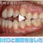 主訴: 受け口と開咬が気になるが手術はしたくない。 🦷 ⌇ 症状: 歯がでこぼこ(叢生、八重歯)受け口(下顎前突、反対咬合)上下の歯が咬んでいない(開咬)