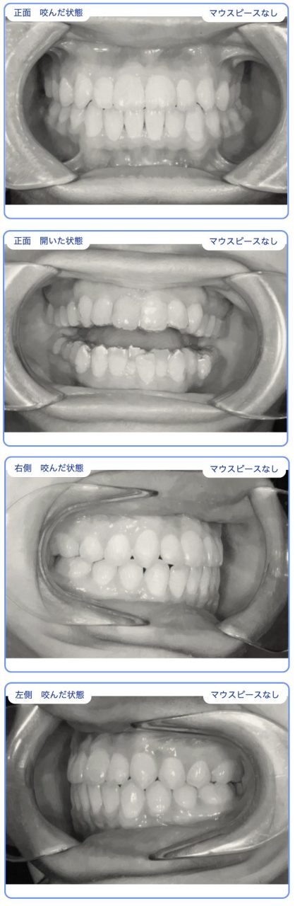 長浦、袖ヶ浦、君津、木更津、インビザライン,小児矯正、マウスピース矯正, デンタルモニタリング,非抜歯,