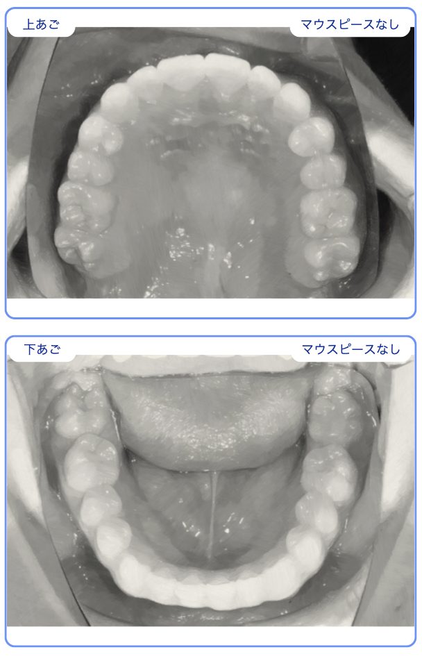 長浦、袖ヶ浦、君津、木更津、インビザライン,小児矯正、マウスピース矯正, デンタルモニタリング,非抜歯,