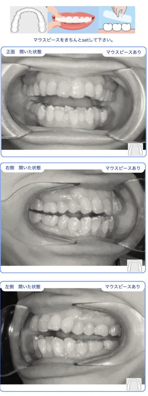 長浦、袖ヶ浦、君津、木更津、インビザライン,小児矯正、マウスピース矯正, デンタルモニタリング,非抜歯,