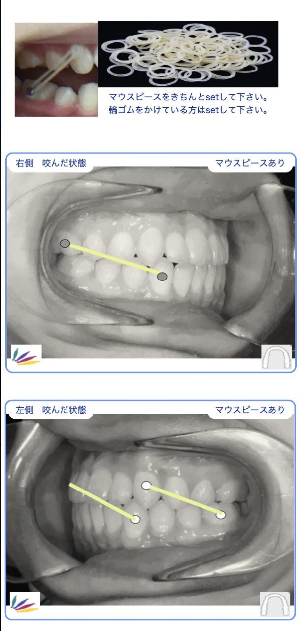 長浦、袖ヶ浦、君津、木更津、インビザライン,小児矯正、マウスピース矯正, デンタルモニタリング,非抜歯,